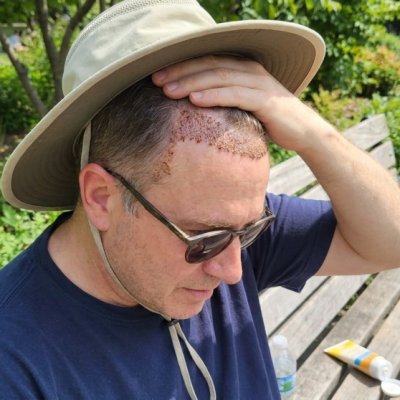 male-pattern-baldness-medication-surgery-threshold