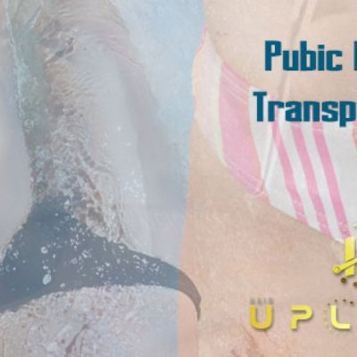 pubic hair transplantation for female