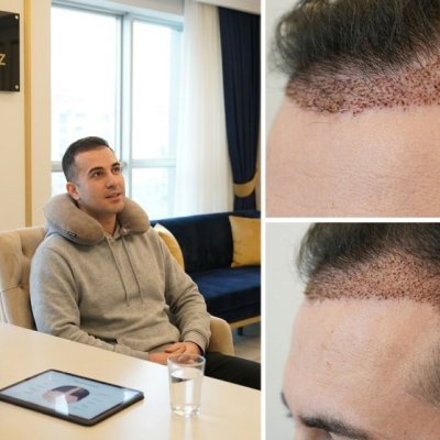 Sedated Hair Transplant vs Staying Awake: What to Expect cover