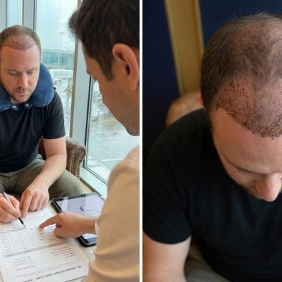 Türkische-Haartransplantation-Kostenrechnung
