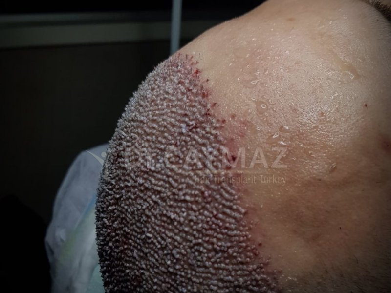 Hair Implantation