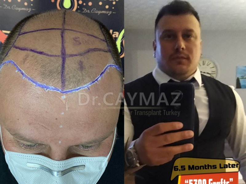 Hair Transplant Turkey Results