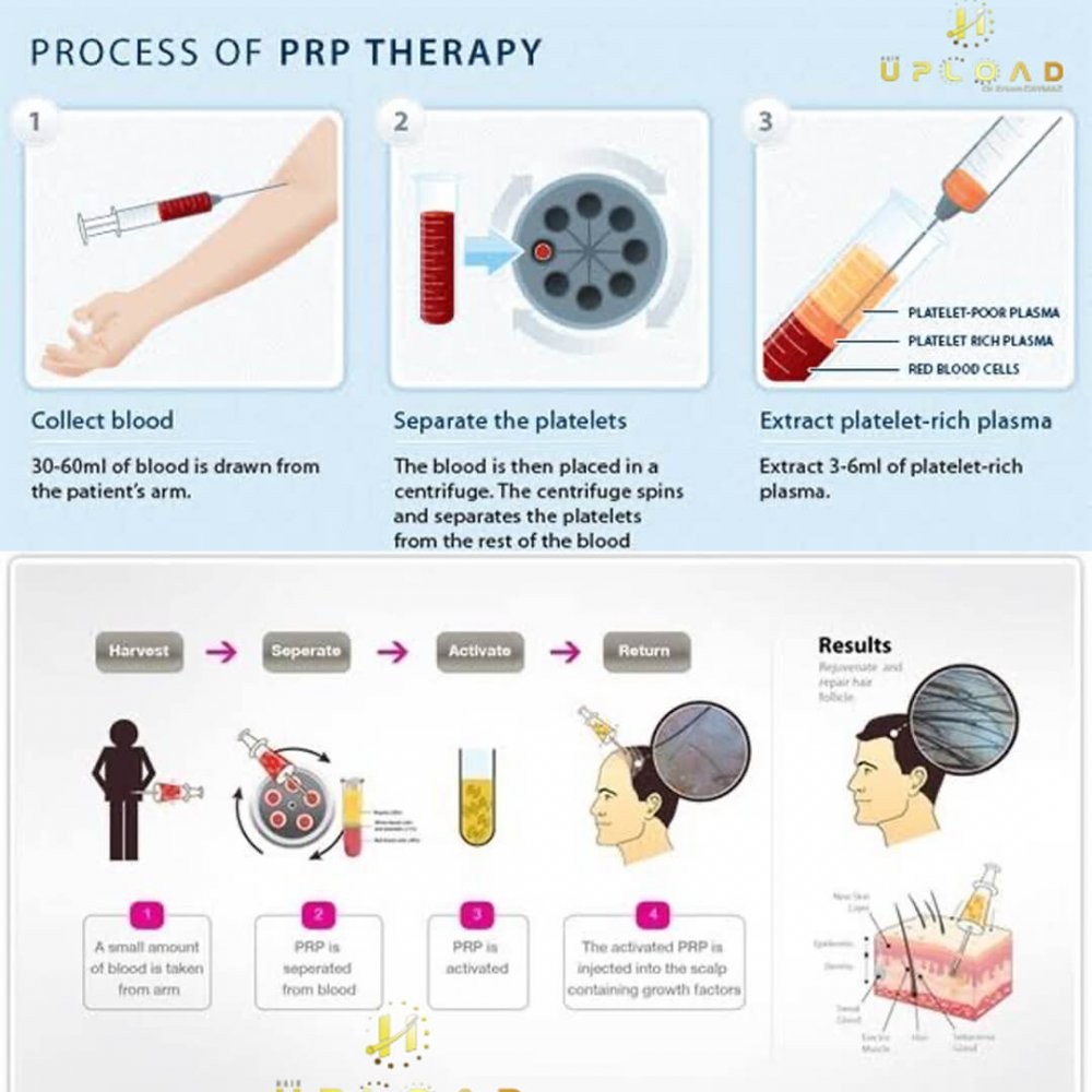 What is the PRP? | Dr Erkam Caymaz Hair Transplant Turkey Istanbul