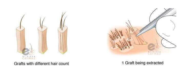 1 Graft How Much Hair Follicle? | Dr Erkam Caymaz Hair Transplant Turkey  Istanbul