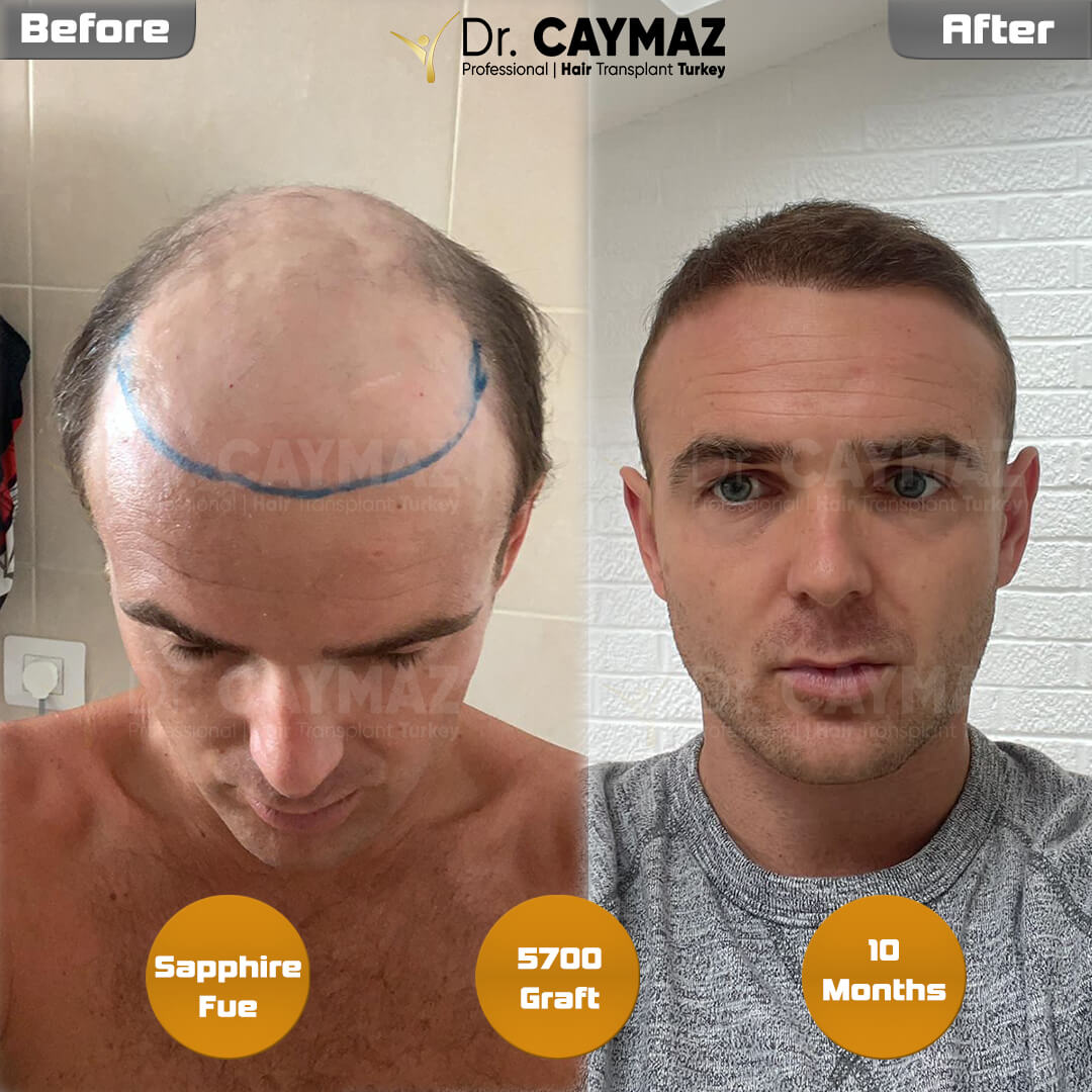 10 Months 5700 Graft 4