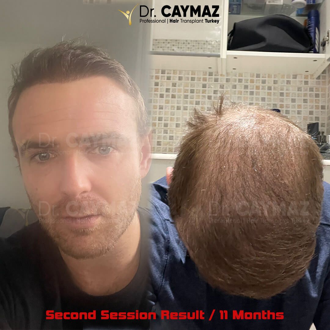 11 Months Second Session