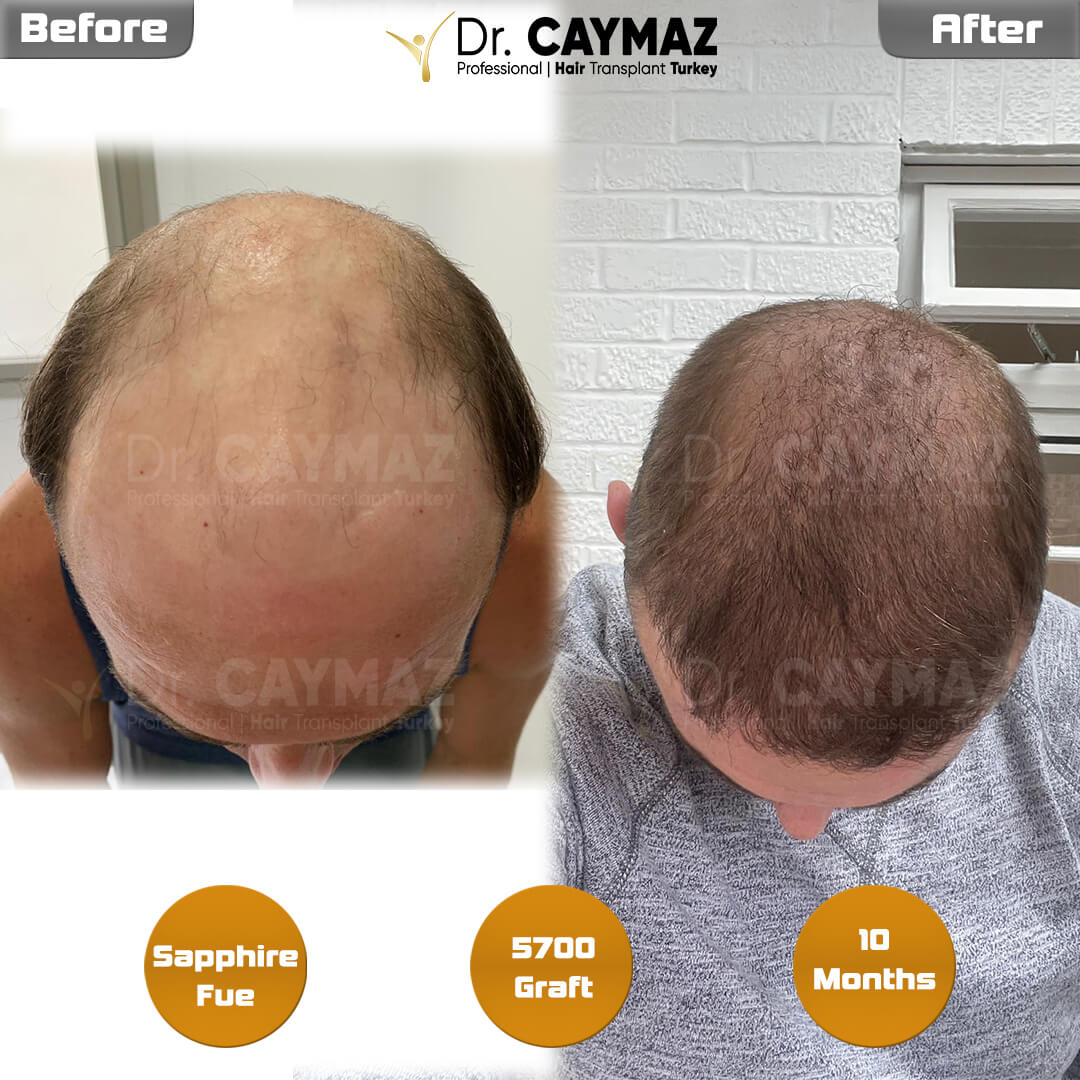 5700 Graft 10 Months 2