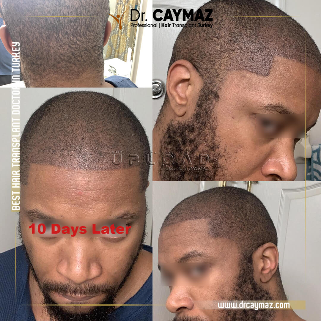 Afro-American Hairline & Transplant