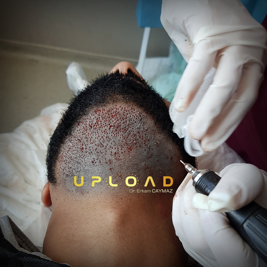 Beard donor area used when combining beard and scalp transplantation