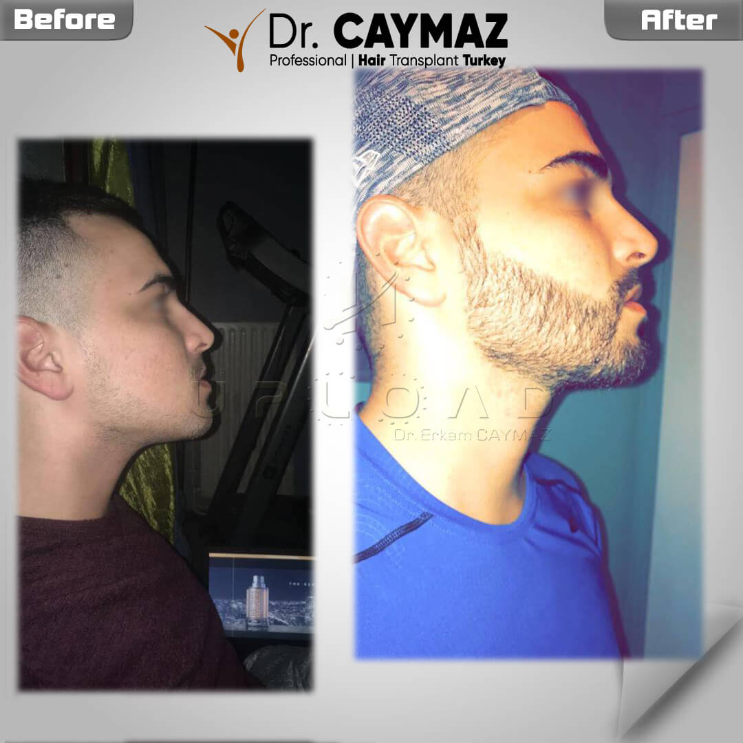 Beard Transplantation 212