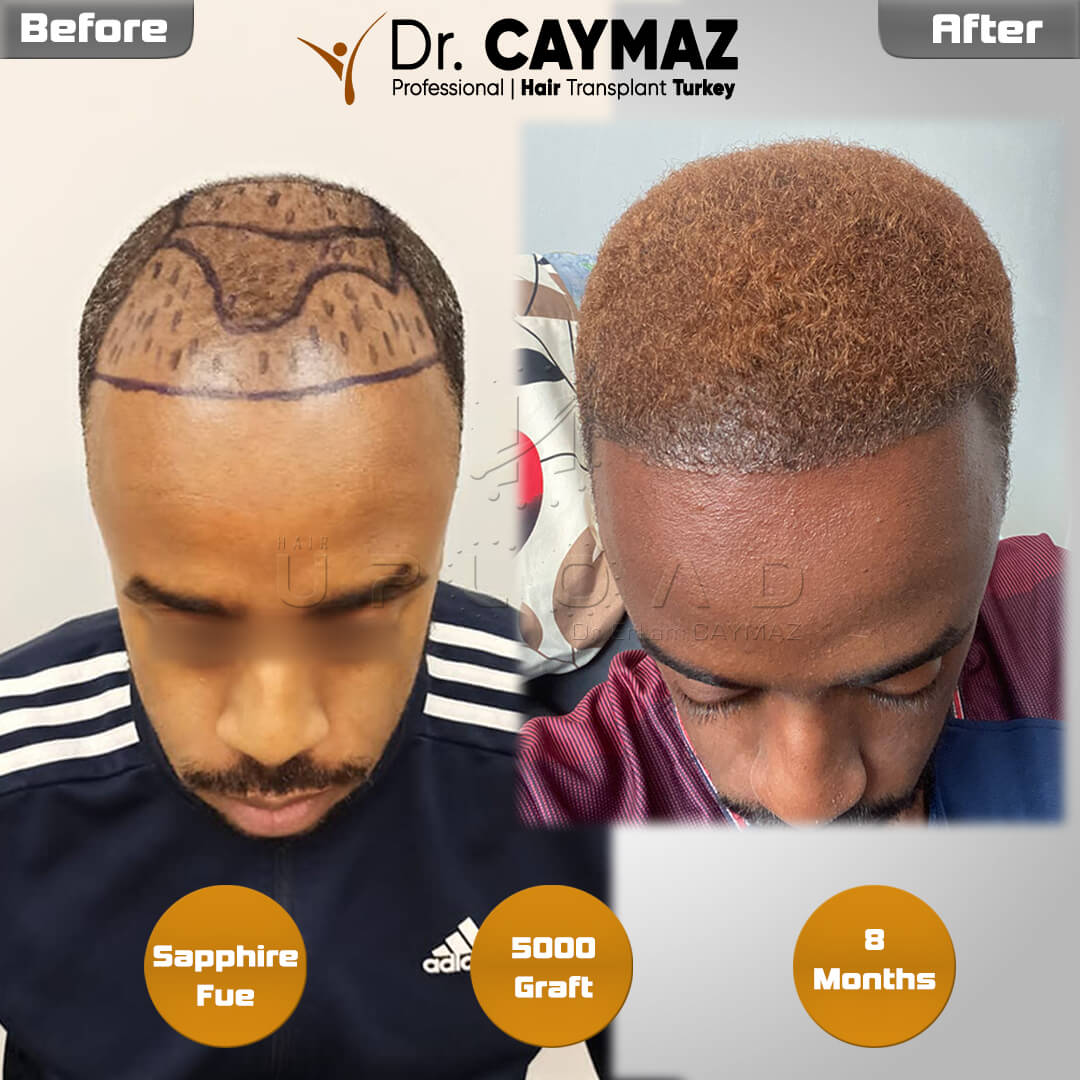 Before and after Afro-American hair transplant approximately eight months