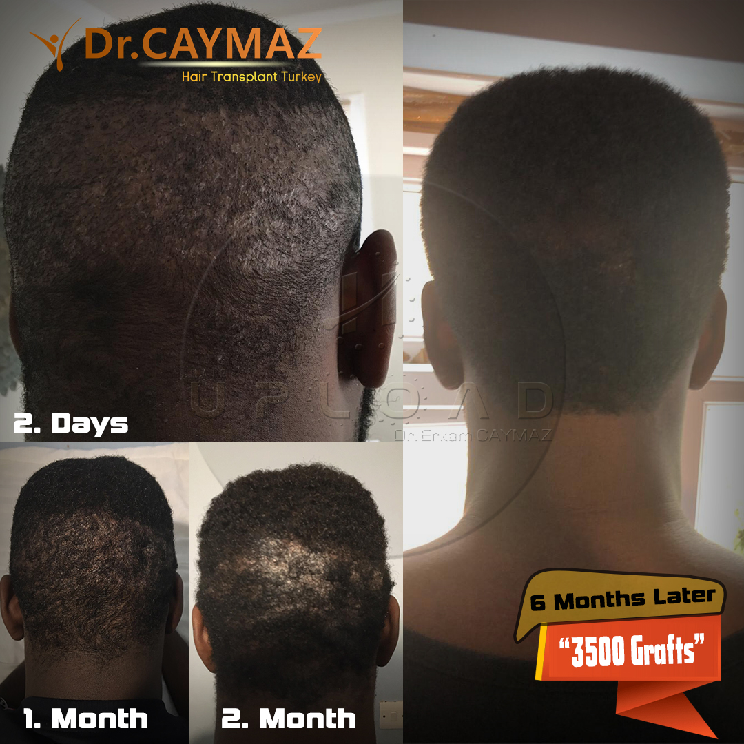 Dr Caymaz Afrotype Hair Transplant Result 6 Month