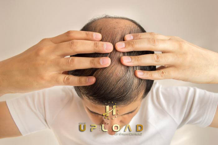 Finasteride Using