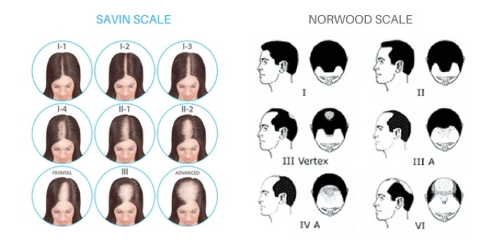 Norwood Hamilton scale diagram